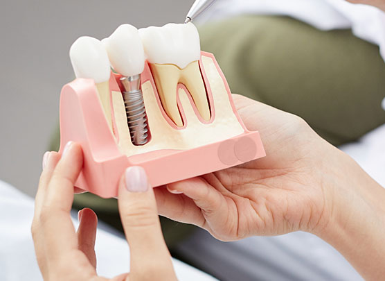 Model of dental implant