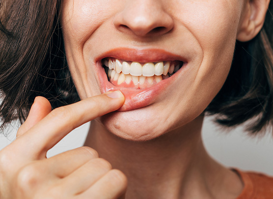 Woman showing her gums