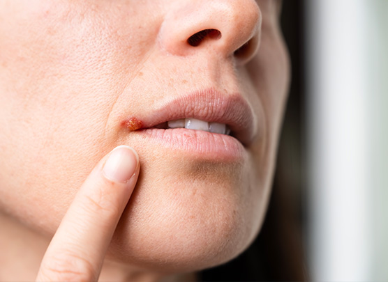 Canker sore