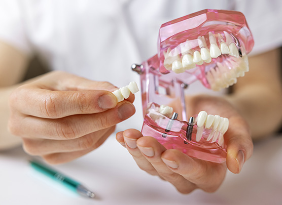 Multiple tooth dental implant
