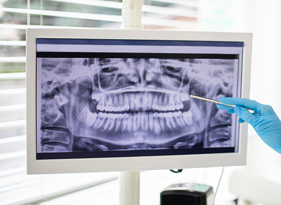 X-ray of wisdom tooth